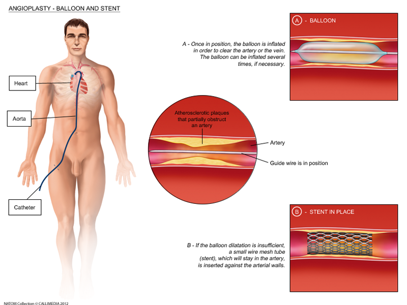 angioplasty and stent