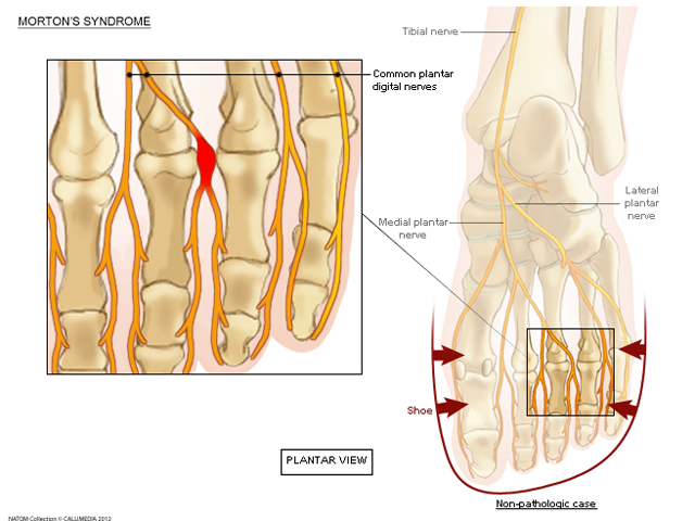 foot neuroma