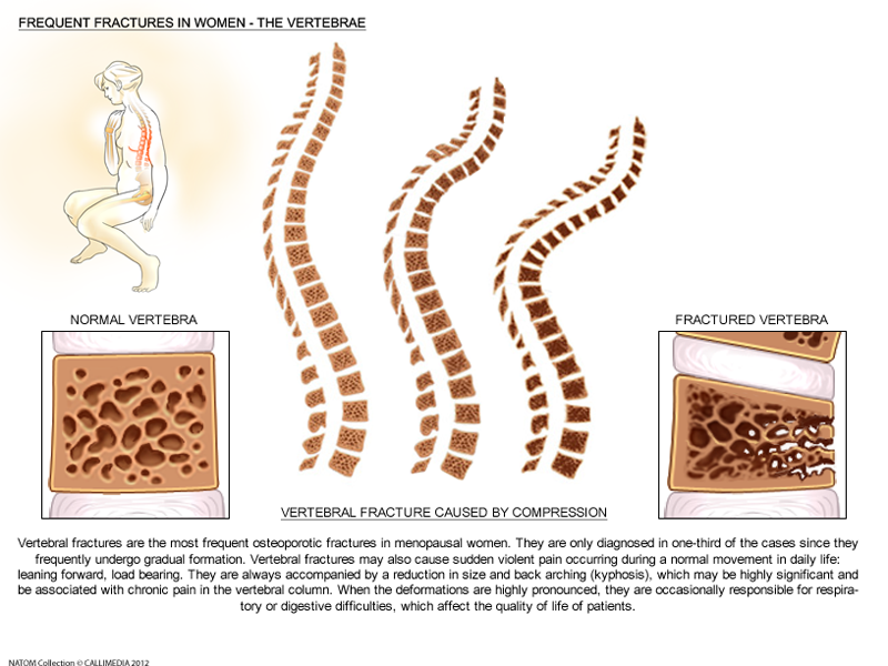 lumbar   Vertebral fractures  osteoporosis