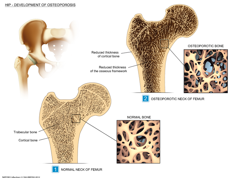 osteoporosis 2