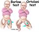 Hip   Otolani and Barlows hip dysplasia test