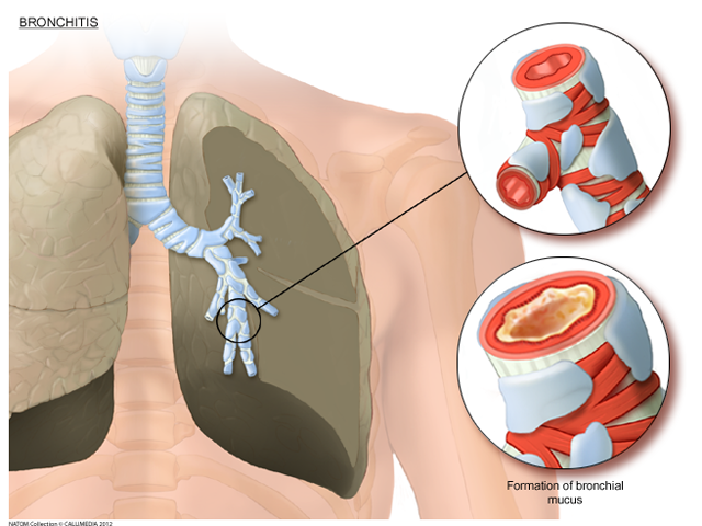 COPD Bronchitis