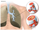 COPD Bronchitis