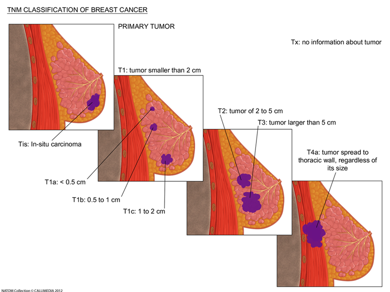 Clasification of breast cancer