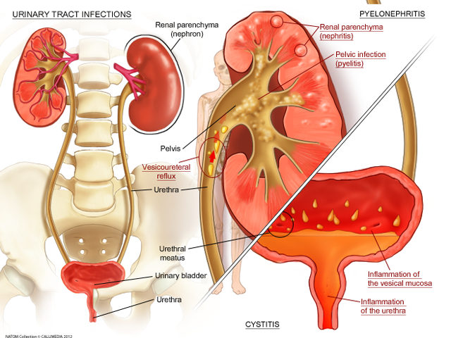 Urinary tract  female and infections along the tract