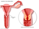 Uterine cervix and cervical smear   cervial cancer