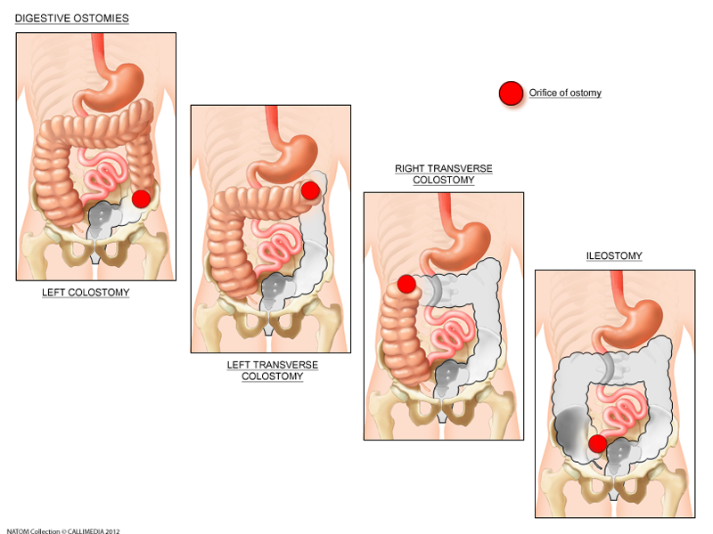 Various Ostomies.png