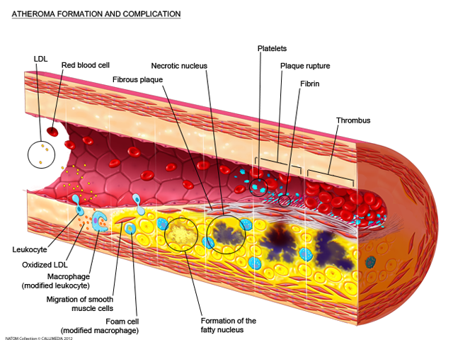 lipids- artheroma.png