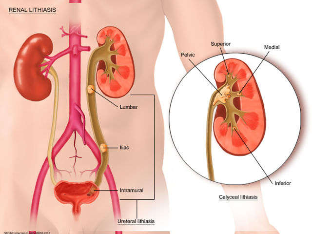 renal stones.png