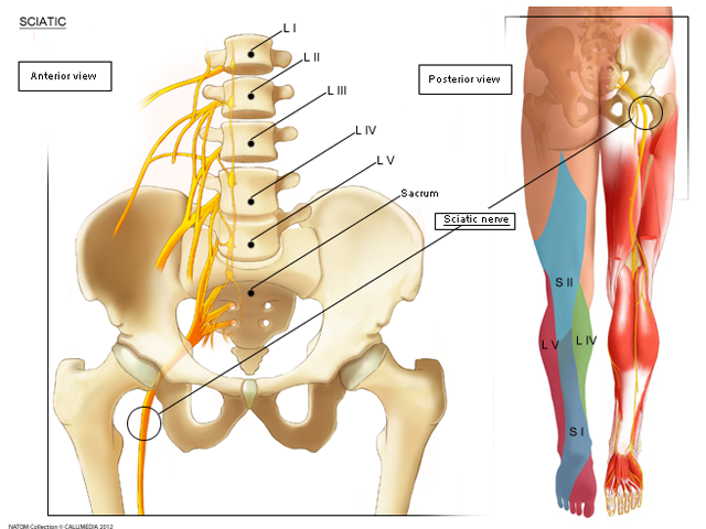 Sciatica 1.png