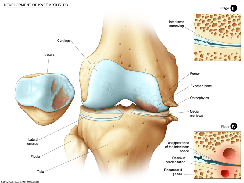 knee arthritis.png