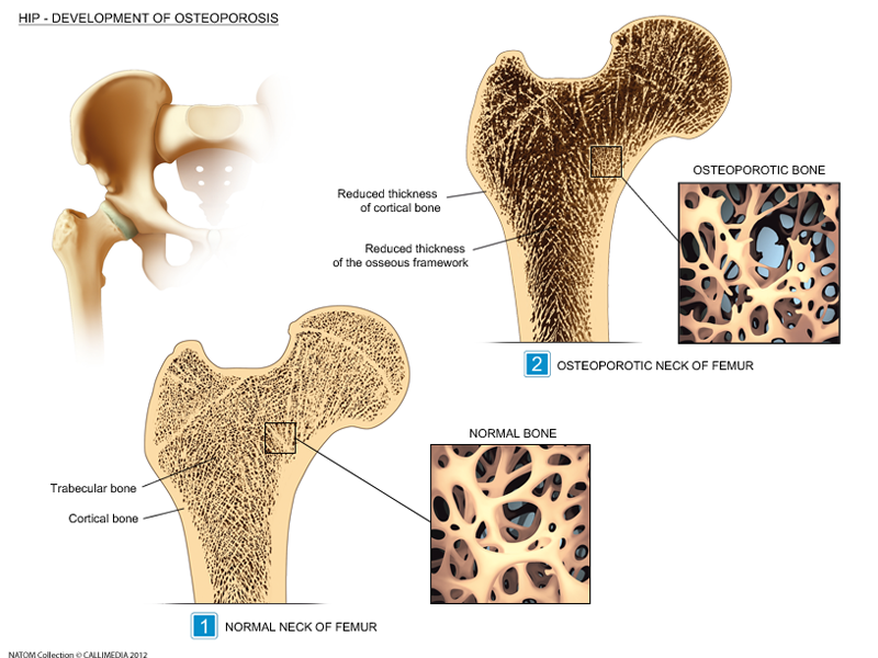 osteoporosis 2.png