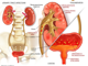 Urinary tract- female and infections along the tract.png