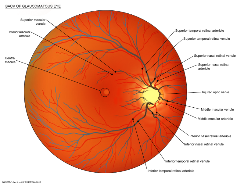 back of glaucomatous eye.png