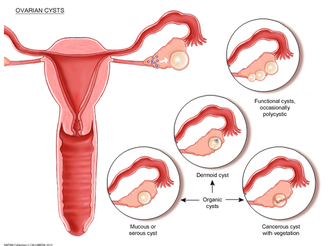 ovarian - cysts.png