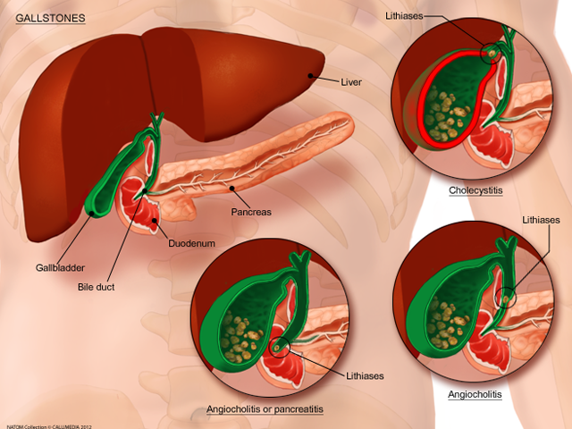 gallstones.png