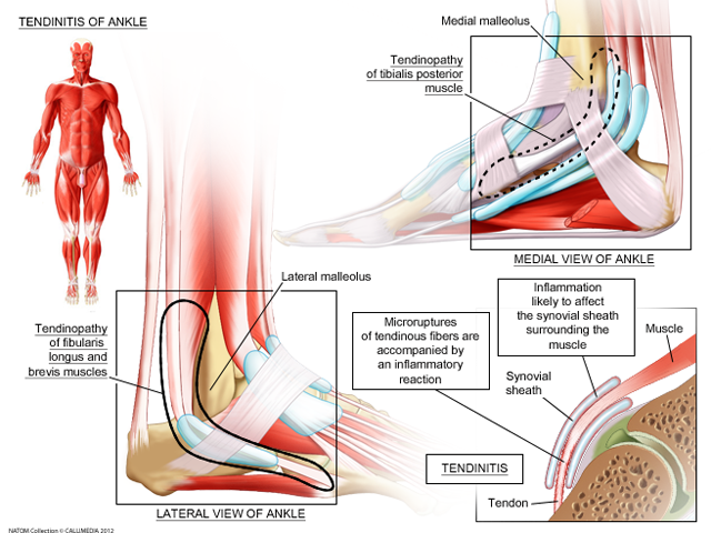 ankle-tendinitis.png