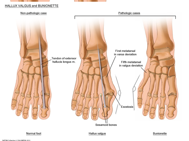 foot hallux valgus- bunions.png