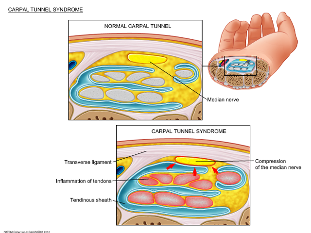 carpal tunnel syndrome.png