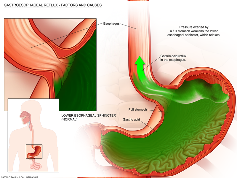 Gastric reflux 1.png