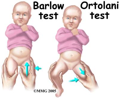 Hip - Otolani and Barlows hip dysplasia test.jpg