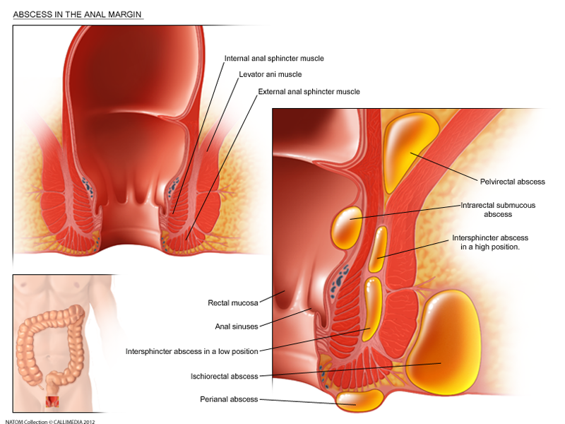 Peri anal abscess.png