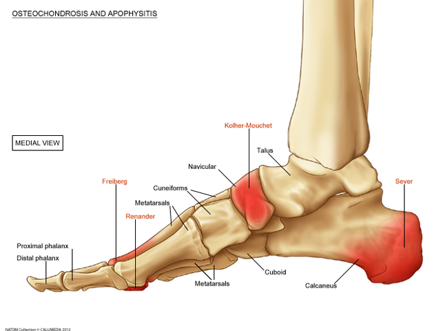 fot osteochondrosis.png