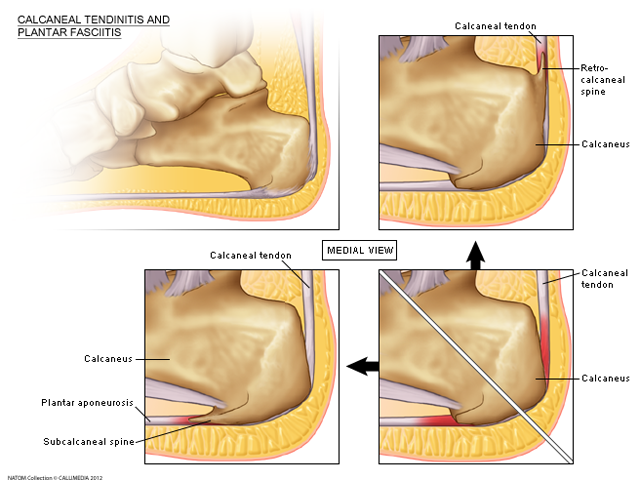 plantar fascitis.png