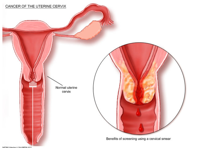 Uterine cervix and cervical smear - cervial cancer.png