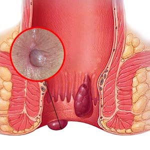 hemorrhoid-picture3.jpg