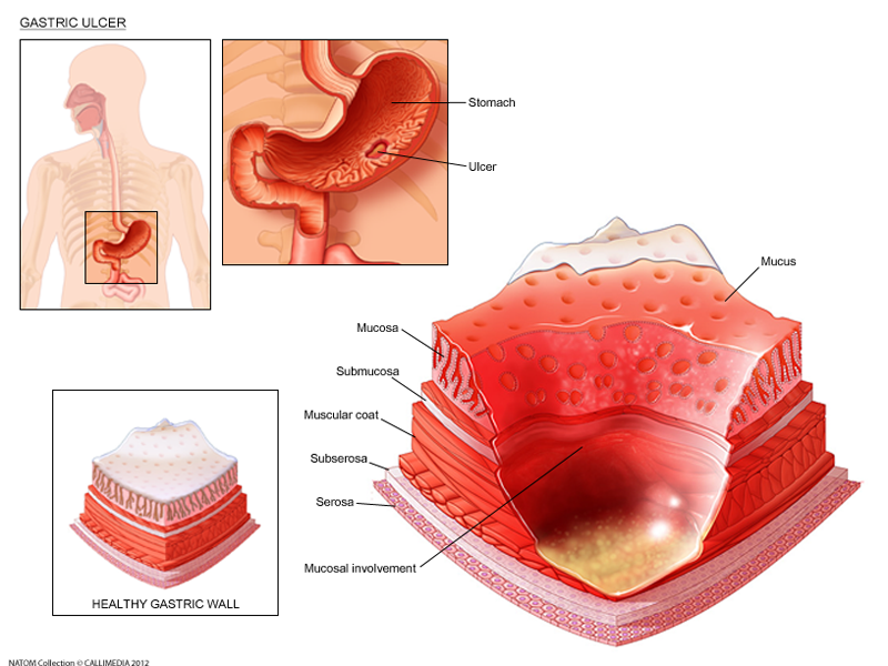 gastric ulcer.png