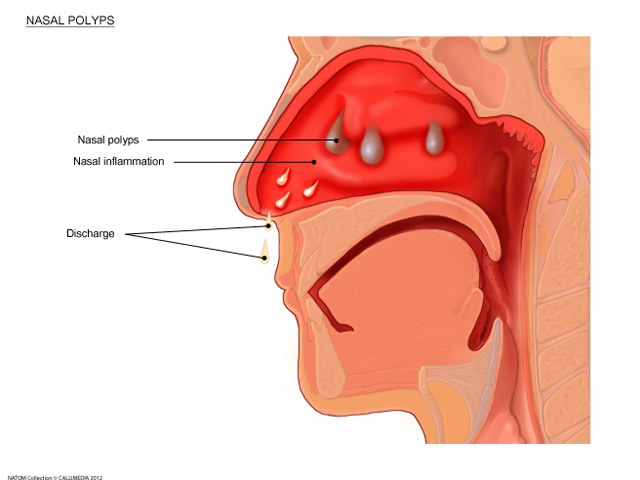 Nose - nasal polyps.png