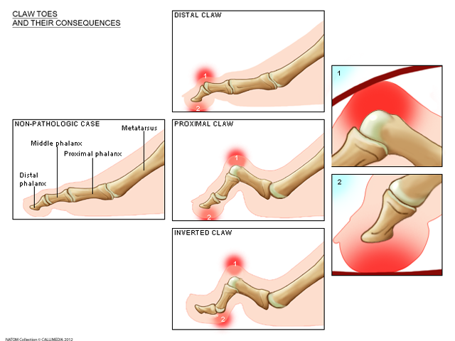 foot claw toe.png