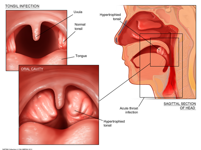 oral cavity - tonsil enlargement.png