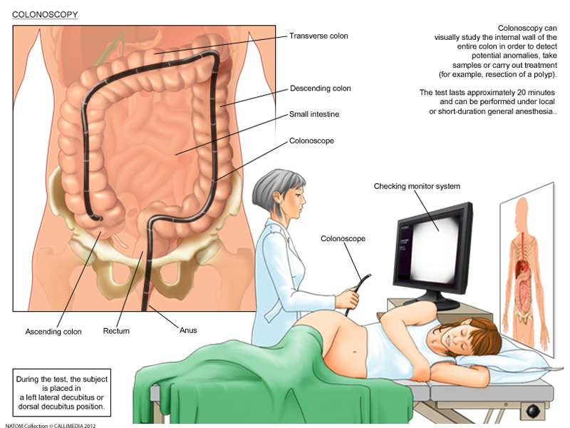 colonoscopy.png