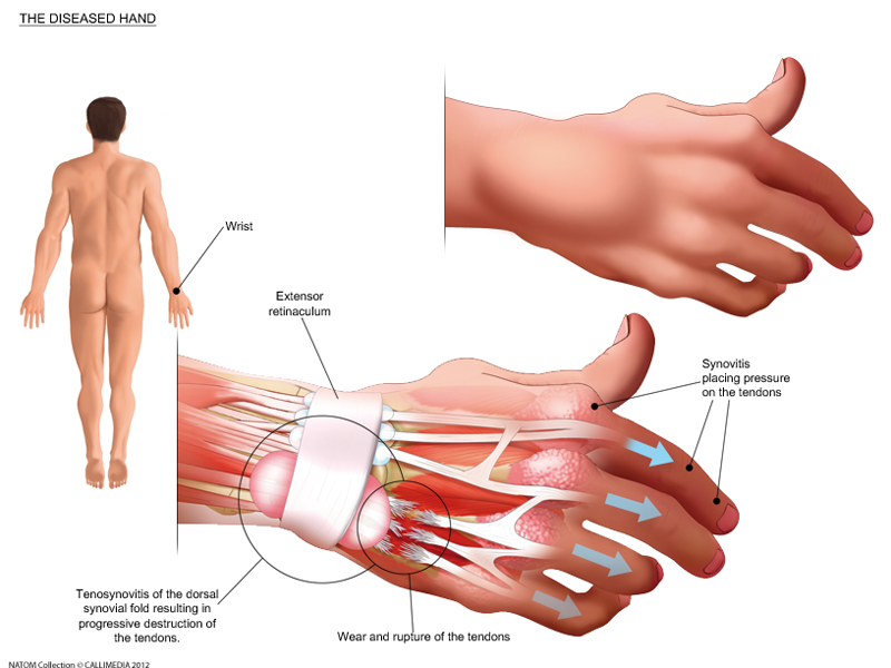 hand-synovitis.png