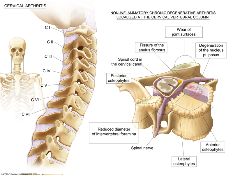 neck arthritis.png