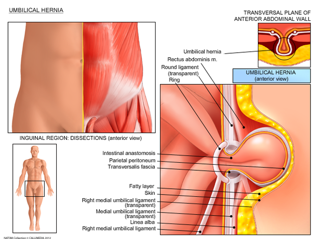 umbilical hernia.png