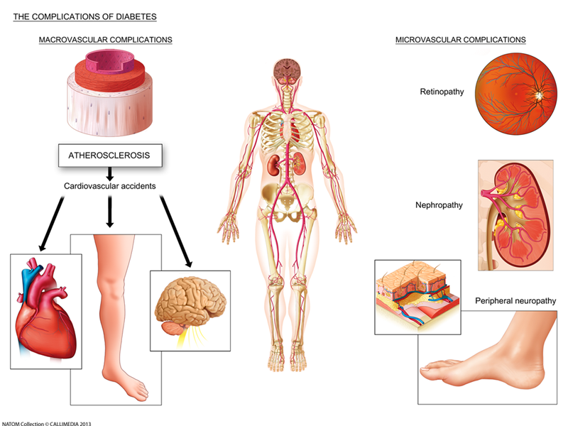 diabetes complications.png