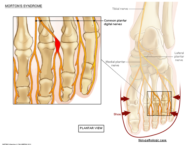 foot neuroma.png