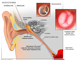 Ear - Acute otitis media-original.png