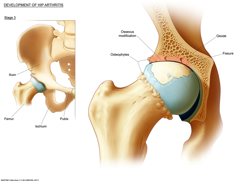 hip arthritis.png