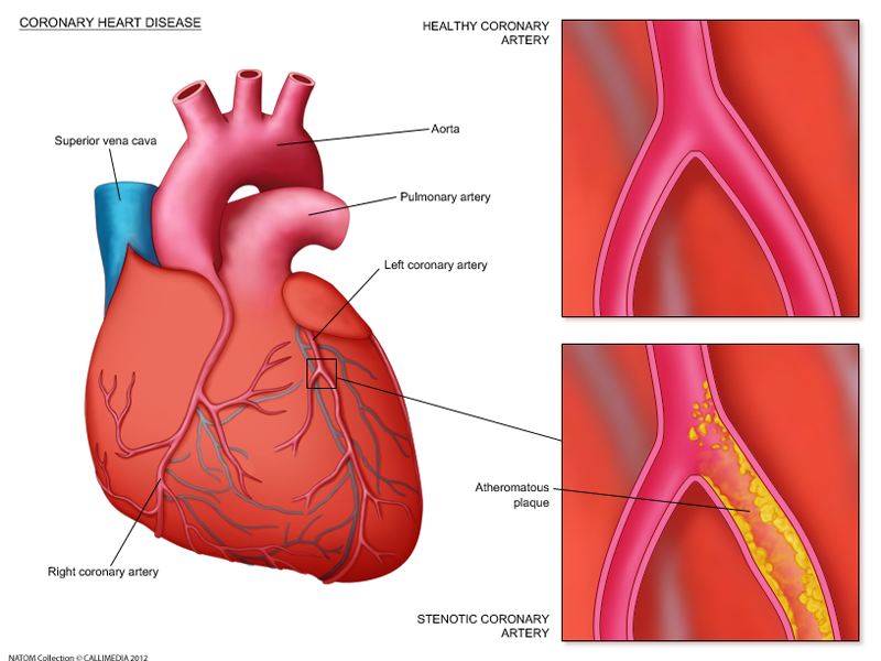 Coronary heart disease.png