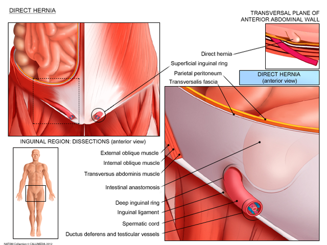 Hernia- direct.png