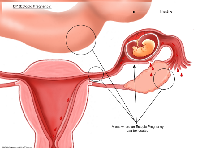 ectopic pregnancy.png