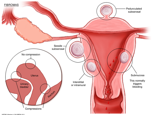 fibroids.png