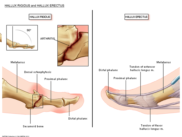 foot hallux rigidus.png