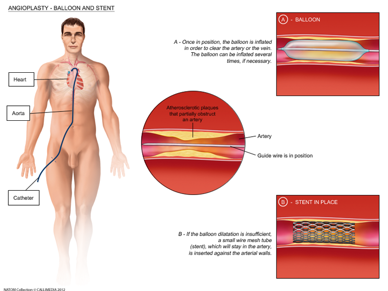 cvs- angioplasty and stent.png