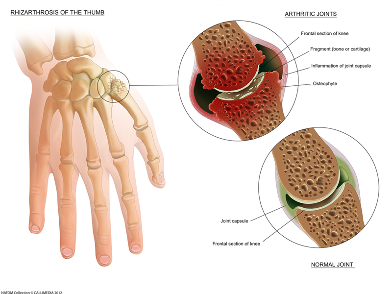 hand arthritis.png