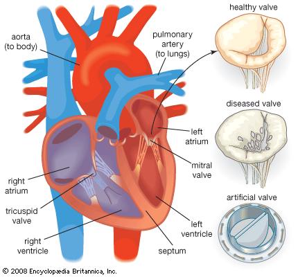 diseased valve.jpg